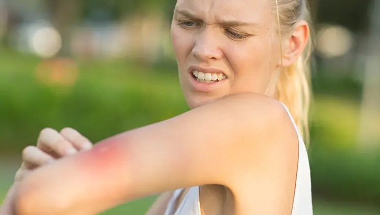 A woman itching an inflamed mosquito bite on their arm.